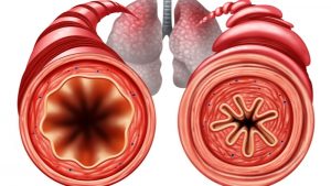 Asthme bronchique-signes et traitement